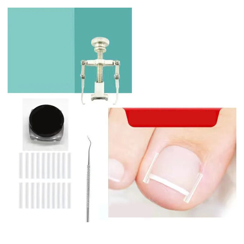 Ingrown Toenail Treatment Corrector Set - Image 9