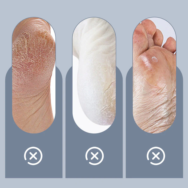 Household Adjustable Electric Foot Callus Remover - Image 2